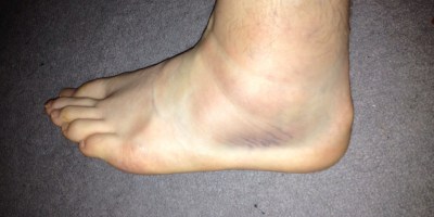Photo of a swollen foot with visible purple bruising under the ankle